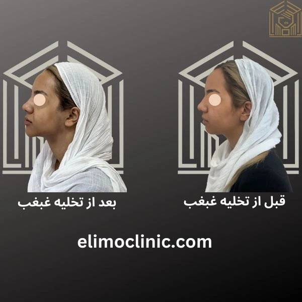 قبل و بعد از عمل تخلیه غبغب