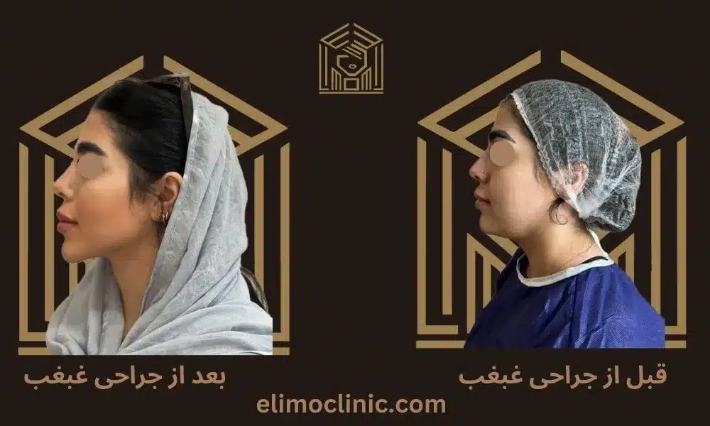 بهترین روش های جراحی غبغب یا لیپوساکشن غبغب