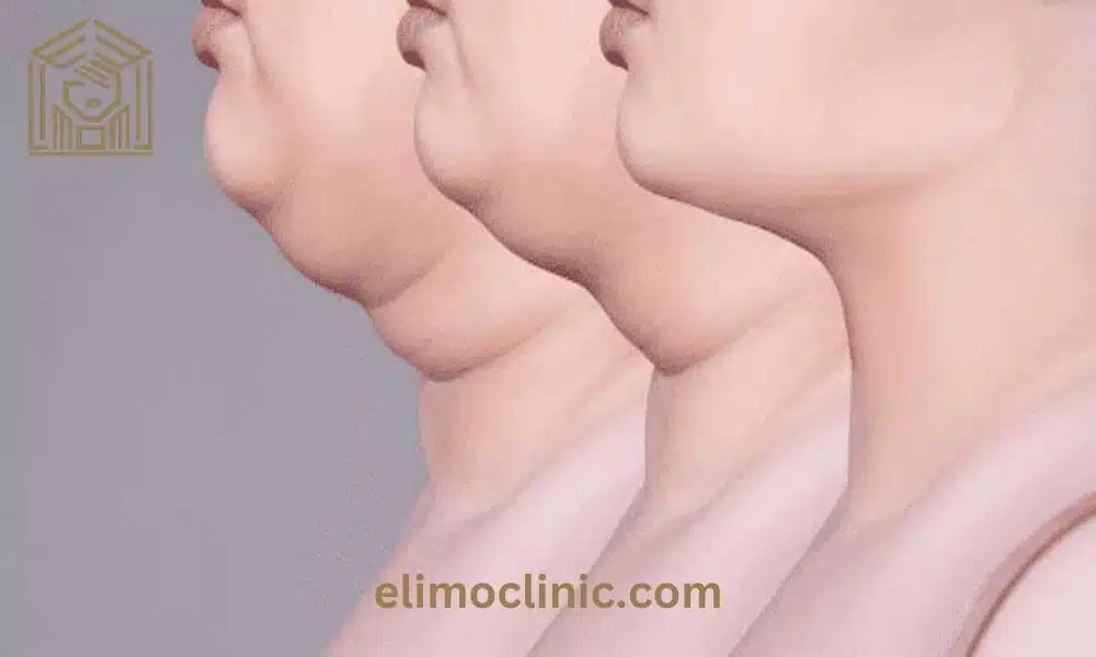 پروسه عمل تخلیه غبغب چگونه است؟
